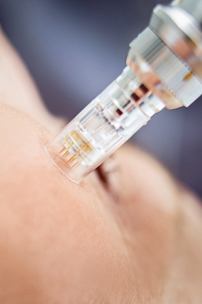 Mikronõelumine-mesopen