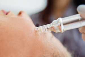 mesopen microneedling